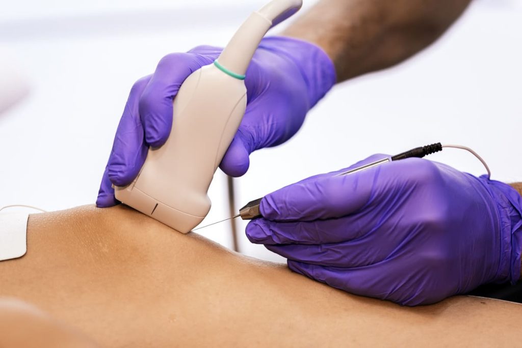 La Electrólisis Percutánea Intratisular (EPI) es una técnica de fisioterapia mínimamente invasiva que se aplica de forma ecoguiada, lo que permite tratar con máxima precisión el tejido lesionado. Actualmente es una de las técnicas con mayor respaldo científico en el tratamiento de lesiones musculoesqueléticas y una de las más utilizadas en el ámbito de la fisioterapia deportiva profesional, tanto en patología crónica como en lesiones agudas.